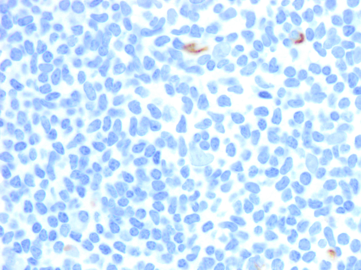 Specimen 3, BM core biopsy, CD34 x 200